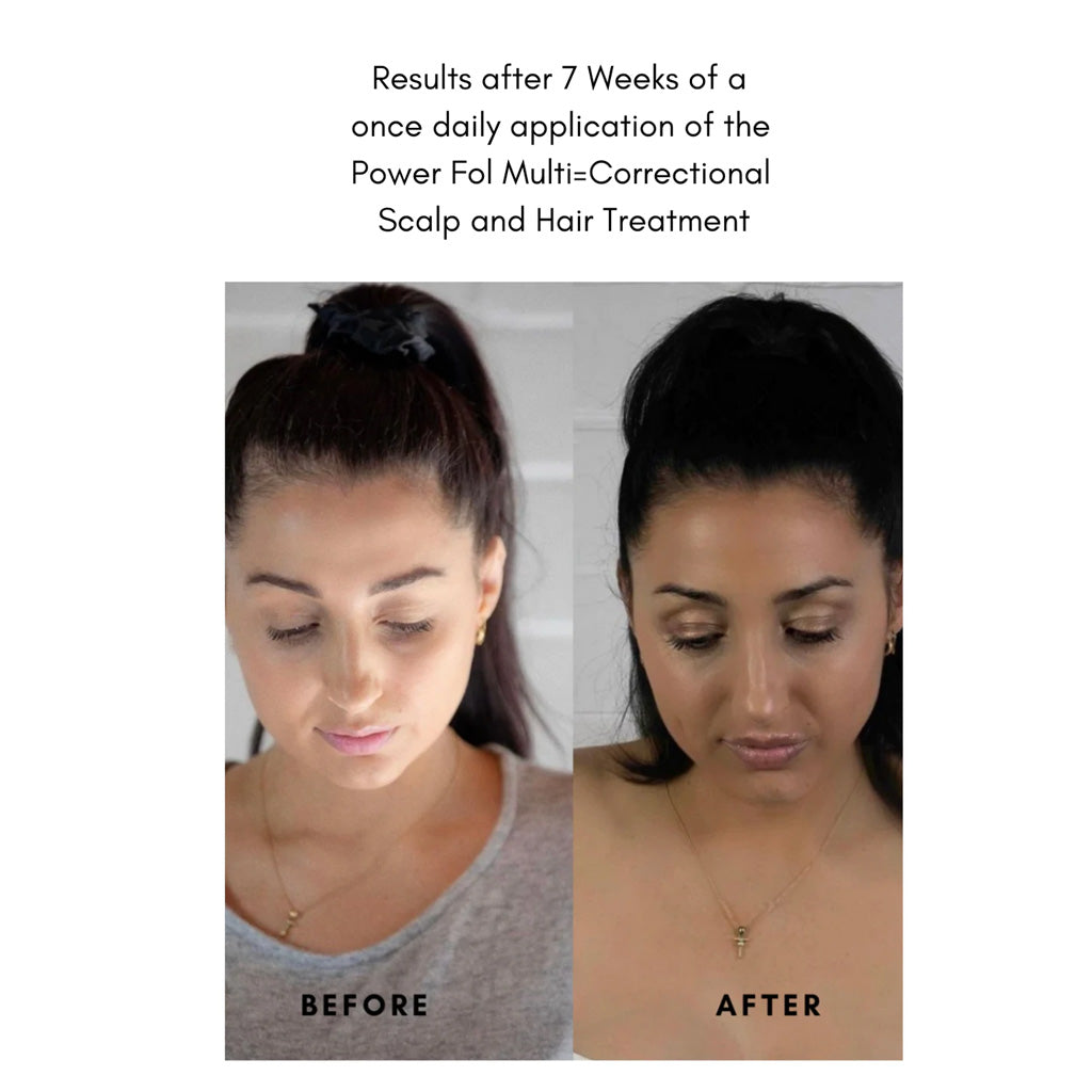 The Power Fol Results of hair loss treatment after 7 weeks