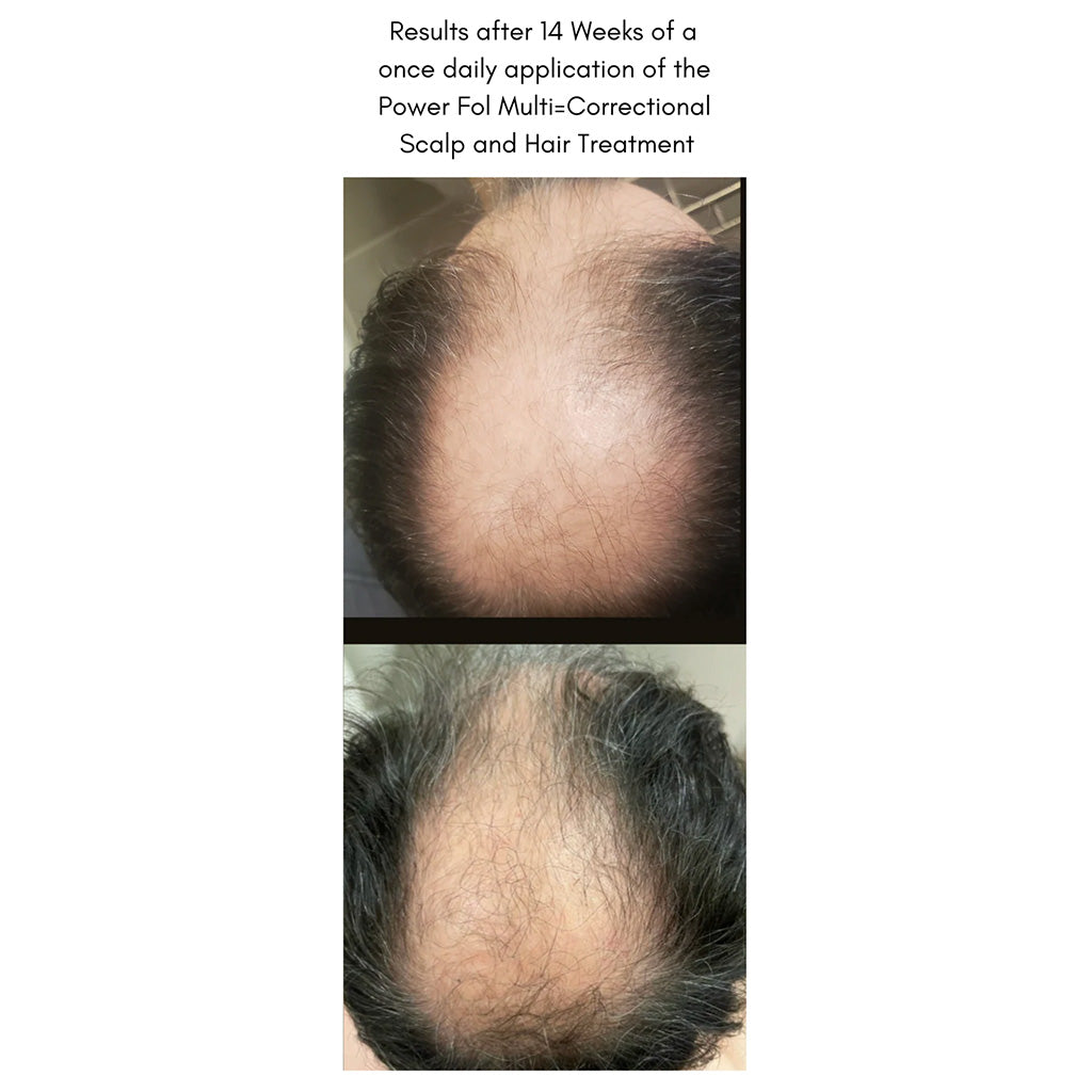 The Power Fol Results of hair loss treatment after 14 weeks on male