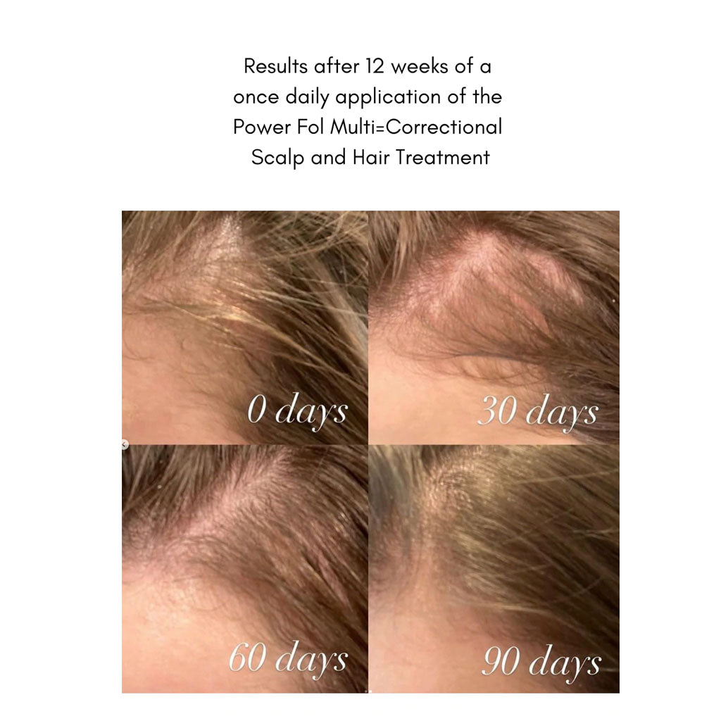 The Power Fol Results of hair loss treatment after 12 weeks