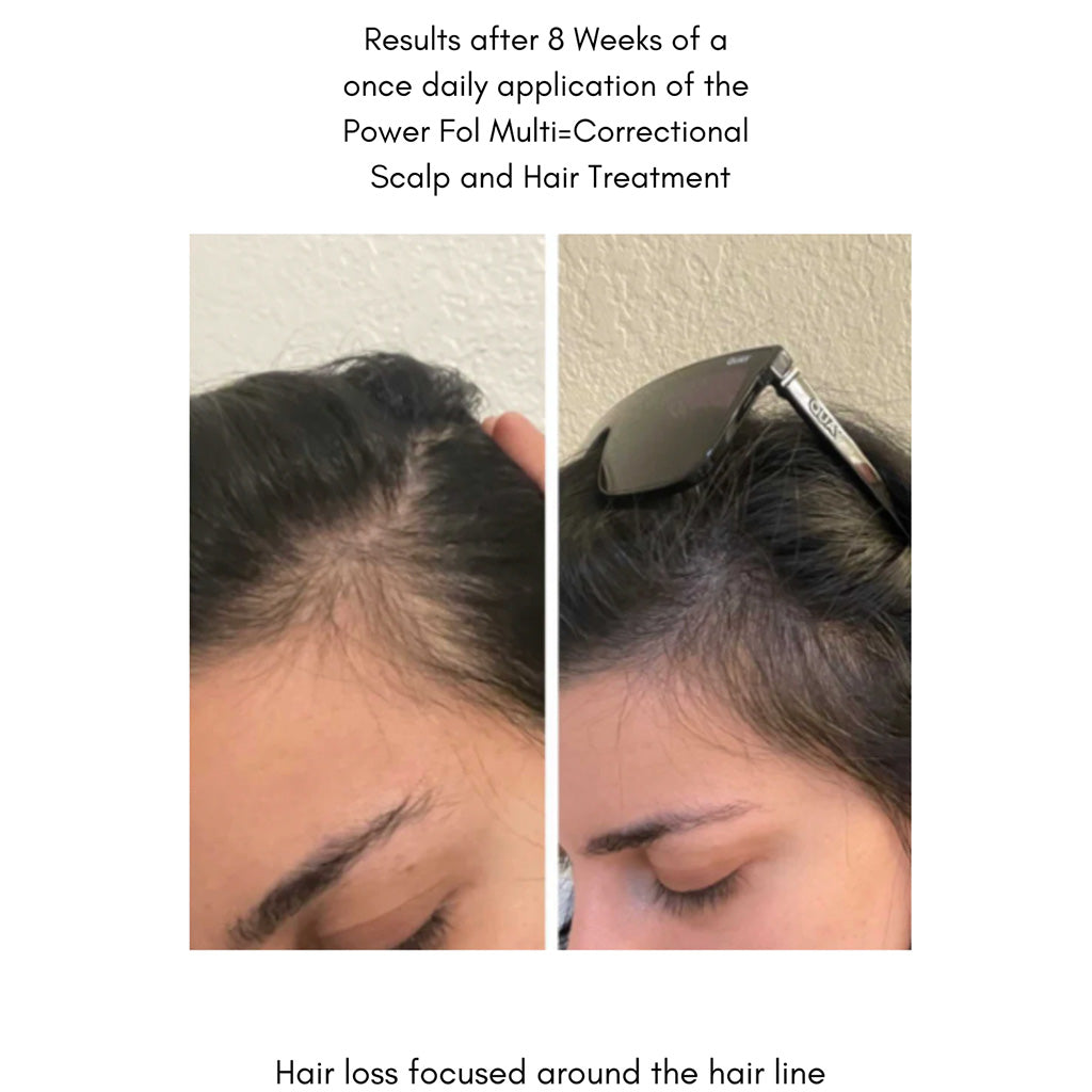 The Power Fol Results of hair loss treatment after 8 weeks